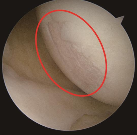 손상된 연골/사진제공=척추 관절 전문 안산 에이스병원