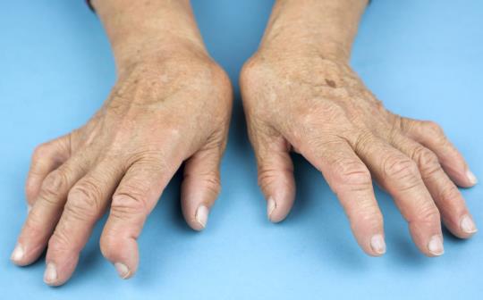  류마티스관절염을 앓고 있는 손/사진제공=안산 에이스병원 