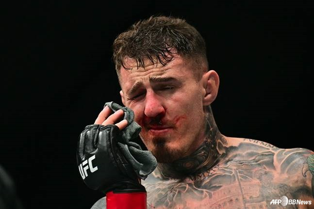 "눈이 보이질 않는다" UFC 챔피언 충격 근황... 명백한 '더티 플레이'→실명 위기 빠졌다