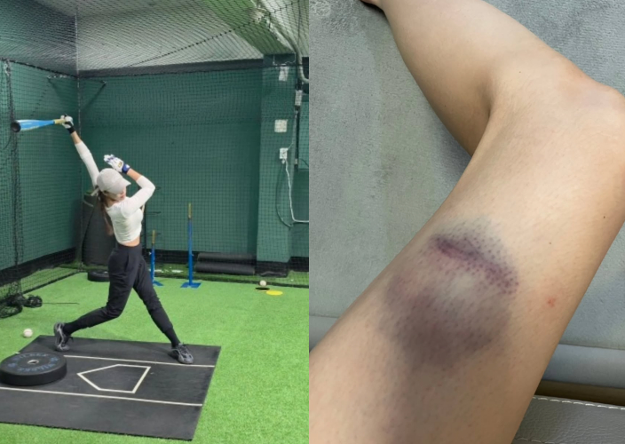 "현역의 마음으로" 신수지, 프로급 타격 자세 감탄..새파란 피멍까지[스타이슈]