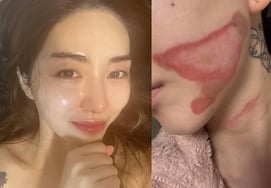 Kwon Min Ah (Highlight) kêu gọi thiệt hại do bỏng độ 2 sau khi phẫu thuật da [Star Issue]