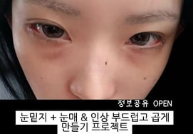 '11 years older ♥' Choi Jun-hee has her second eye plastic surgery before getting married in May.."A beautiful impression, a big success"