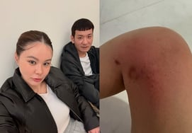 'チョン·ソンホ♥' キョン·マルム、あざだらけの足を公開「狂おしいほどかゆくて耐えられない」