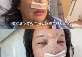 啦啦，整容后的样子..女儿也受到惊吓的浮肿和淤青:"好像被蜜蜂蜇了500枪"