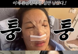 ララ、鼻整形手術→8日で腫れが引いた..怖がっていた娘もびっくり [スター・イシュー]