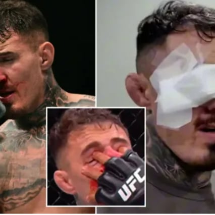 "끝내 시력 잃었다... 나 같은 실수는 하지 말길" UFC 챔피언 여전히 복귀 불투명→아찔했던 레전드 '후회 고백'