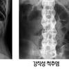 허리 뻣뻣하면 강직성 척추염 의심