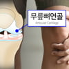 무릎 골관절염, 치료는 바로바로