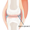 빠를수록 좋은 무릎 골관절염 치료