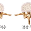 [신승준 척추비법] 발 통증, 허리 문제일 수도