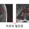 [신승준 척추비법] 척추의 혈관종