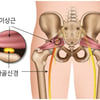[김태겸 척추이야기] 다리 통증, 이상근 증후군