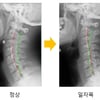 [김태겸의 척추이야기] 경추 통증, 일자목 증후군