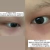 클루씨 이채린, 7차 항암 중 부작용 걱정 "눈 위아래  빨개"
