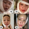 유깻잎, 성형수술 후 회복기..퉁퉁 부은 얼굴에 붕대 칭칭