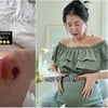'쌍둥이 임신' 김지혜, 무릎에 피멍..심각했던 낙상사고 부상 '응원'