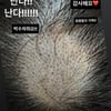 '이솔이♥' 박성광, 원형탈모 극복 중..벗겨진 두피서 자라난 머리카락 "난다!"