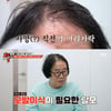 최양락, 쌍꺼풀→리프팅 성형 다 했는데 모발 이식 거부.."수명 3년" [1호가] [★밤TView]