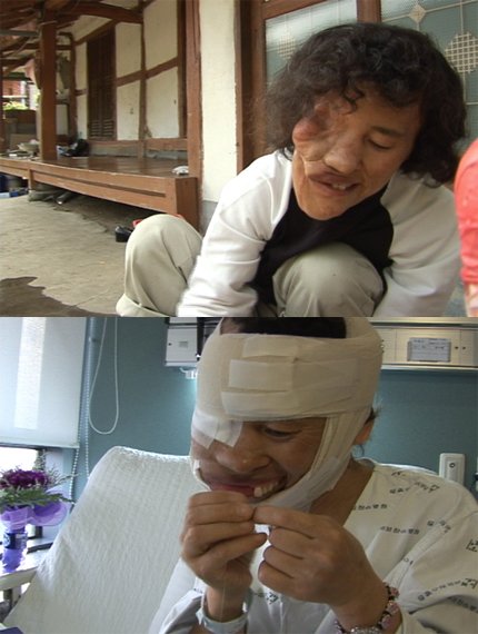 박필순 씨의 수술 전(위)과 후의 모습.
