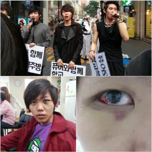 눈 부상을 당한 정빈 / 사진제공=퓨어엔터테인먼트