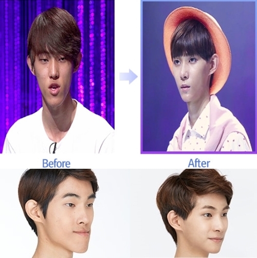 렛미남 양정현 수술 전 후 /사진= 스토리온 방송 캡처