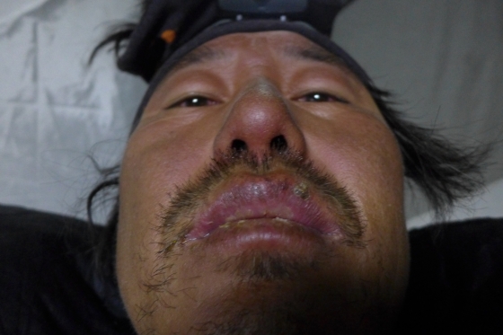 백홍종 '학교 가는 길' 촬영감독이 혹한 속 동상으로 피부 손상을 당한 모습 /사진제공=백홍종