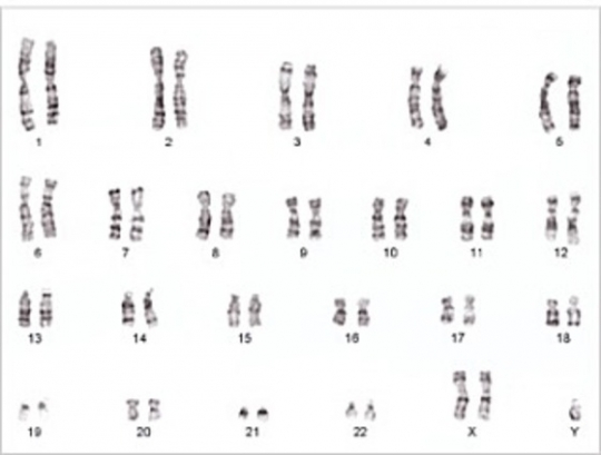 클라인펠터 증후군 환자의 염색체. /사진=뉴스1