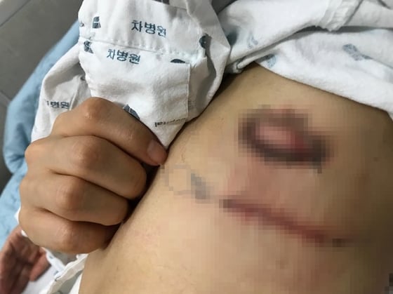 한예슬이 20일 인스타그램을 통해 공개한 지방종 제거 수술 부위/사진=한예슬 인스타그램