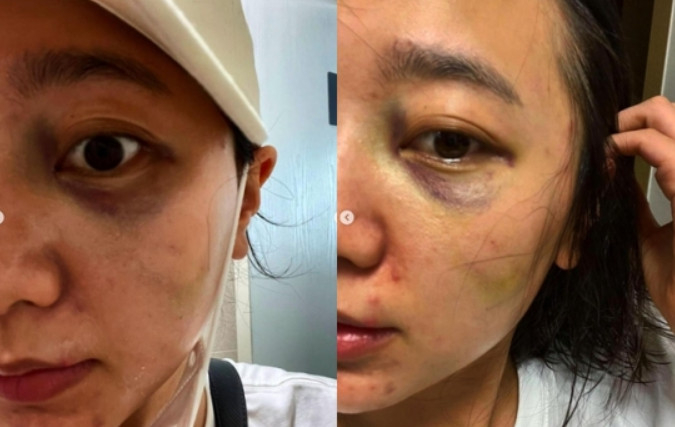 과거 서사랑이 가정폭력을 당했음을 고백하며 피해 증거를 올렸다. /사진=인스타그램